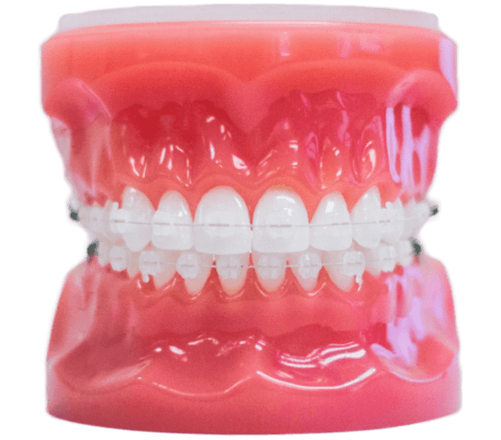invisalign aligners on plastic model