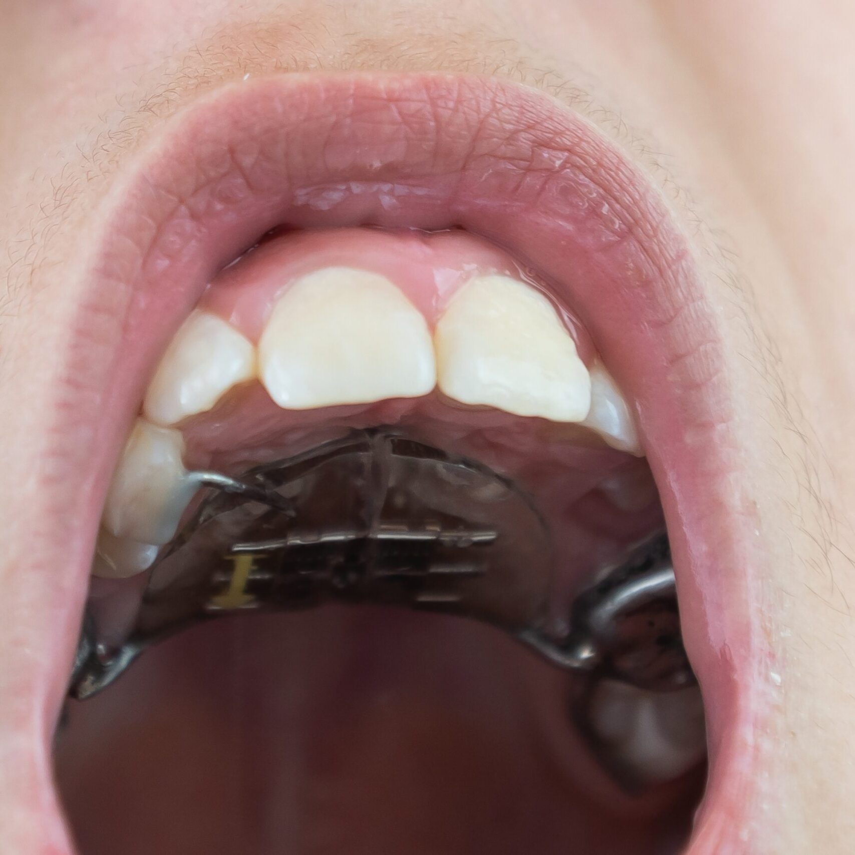 Little,Girl,With,A,Plate,On,Her,Teeth